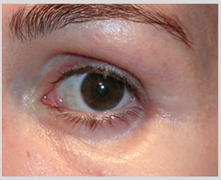 眼袋處理已不再純去油—新觀念眼袋新手術( 防止傳統去油後眼球凹陷之骷髏眼)