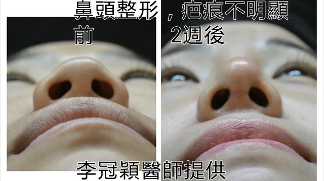 妳真的需要縮鼻翼嗎?